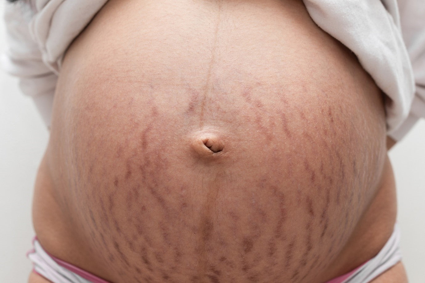 Pregnancy stretch marks - cause and cure